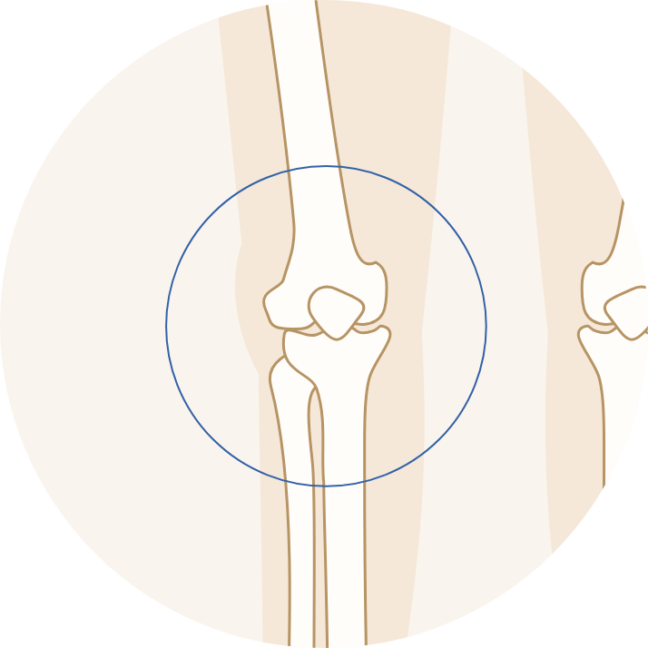 関節の腫れ部分のイラスト